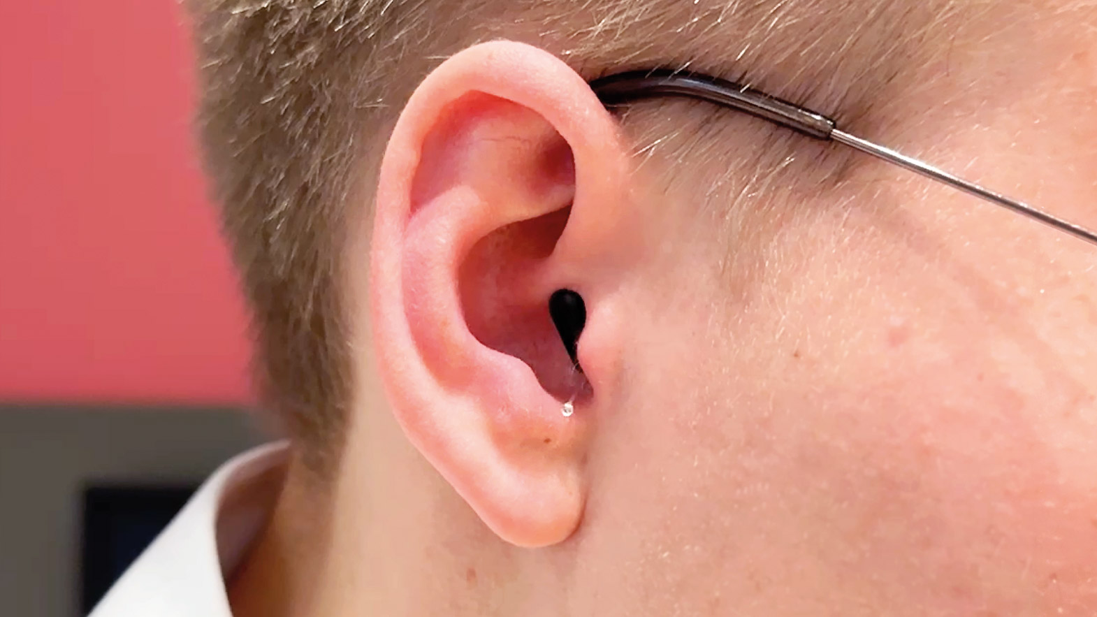 Tragebild des Signia Silk C&G IX mit Hörluchs Titanotplastik im Ohr. Das kleine Hörgerät verschwindet nahezu unsichtbar im Gehörgang. Lediglich der transparente Zugfaden ist von Vorne dezent zu sehen.